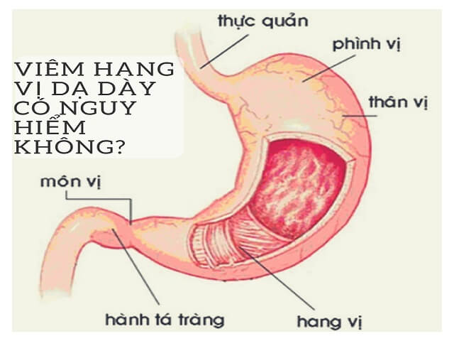 Viêm hang vị dạ dày - Hình ảnh minh họa